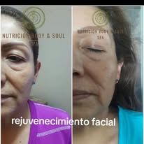 Antes y después tratamiento facial 3