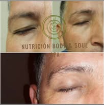 Antes y después tratamiento facial 4