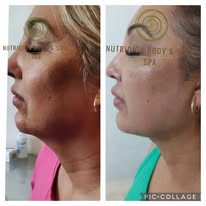 Antes y después tratamiento facial 5